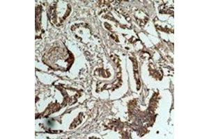 Immunohistochemical analysis of Cyclin B1 staining in human breast cancer formalin fixed paraffin embedded tissue section. (Cyclin B1 抗体)