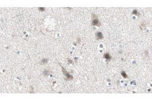 ABIN6274945 at 1/100 staining Human brain cancer tissue by IHC-P. (ABCC3 抗体  (Internal Region))