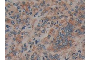 Detection of PRLR in Human Lung cancer Tissue using Polyclonal Antibody to Prolactin Receptor (PRLR)