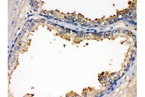 Anti- BMPR1B Picoband antibody,IHC(P) IHC(P): Human Prostatic Cancer Tissue (BMPR1B 抗体  (AA 14-184))