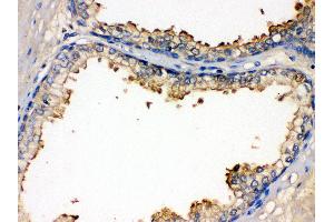 Anti- BMPR1B Picoband antibody,IHC(P) IHC(P): Human Prostatic Cancer Tissue