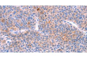 Immunohistochemistry of paraffin-embedded Human liver cancer using AADAC Polyclonal Antibody at dilution of 1:30 (AADAC 抗体)