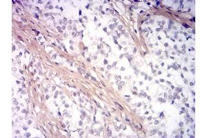 Immunohistochemical analysis of paraffin-embedded bladder cancer tissues using PINK1 mouse mAb with DAB staining. (PINK1 抗体  (AA 112-273))