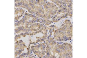 Immunohistochemistry of paraffin-embedded human thyroid cancer using XRCC2 antibody.