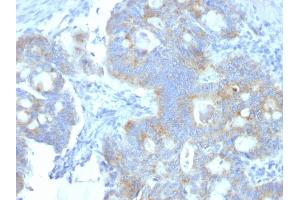 Formalin-fixed, paraffin-embedded human Colon Carcinoma stained with Heparan Sulfate Monoclonal Antibody (A7L6). (HSPG2 抗体)