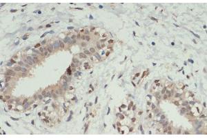 Immunohistochemistry of paraffin-embedded Human breast cancer using KDM6A Polyclonal Antibody at dilution of 1:200 (40x lens). (KDM6A 抗体)