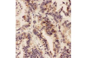 Anti-HSD11B1  antibody, IHC(P)IHC(P): Human Lung Cancer Tissue (HSD11B1 抗体  (N-Term))