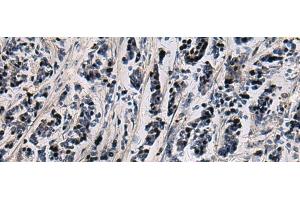 Immunohistochemistry of paraffin-embedded Human breast cancer tissue using SNIP1 Polyclonal Antibody at dilution of 1:80(x200) (SNIP1 抗体)