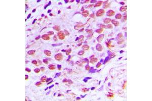 Immunohistochemical analysis of XPA staining in human breast cancer formalin fixed paraffin embedded tissue section. (XPA 抗体  (C-Term))