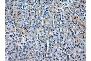 Immunohistochemical staining of paraffin-embedded Adenocarcinoma of Human ovary tissue using anti-PDE4A mouse monoclonal antibody. (PDE4A 抗体)