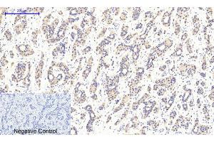 Immunohistochemical analysis of paraffin-embedded human liver cancer tissue. (CaMKIIbeta/gamma/delta 抗体  (pThr287))