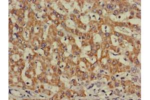 Immunohistochemistry of paraffin-embedded human liver cancer using ABIN7156331 at dilution of 1:100 (Insulin Receptor 抗体  (AA 1023-1298))