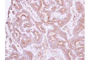 IHC-P Image Immunohistochemical analysis of paraffin-embedded human breast cancer, using NELL1, antibody at 1:250 dilution. (NELL1 抗体  (Center))