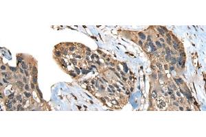 Immunohistochemistry of paraffin-embedded Human esophagus cancer tissue using ATXN3 Polyclonal Antibody at dilution of 1:100(x200) (Ataxin 3 抗体)