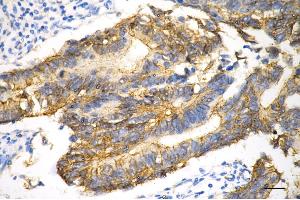 Immunohistochemistry was performed on paraffin-embedded human sigmoid colon carcinoma using catenin beta 1 antibody (ABIN7797931), 1:200). (CTNNB1 抗体)