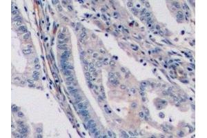 Detection of ENG in Human Endometrial cancer Tissue using Monoclonal Antibody to Endoglin (ENG) (Endoglin 抗体  (AA 336-450))