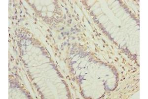 Immunohistochemistry of paraffin-embedded human colon cancer using ABIN7157067 at dilution of 1:100 (NUBPL 抗体  (AA 39-319))