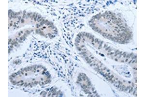 The image on the left is immunohistochemistry of paraffin-embedded Human colon cancer tissue using ABIN7189621(ACIN1 Antibody) at dilution 1/30, on the right is treated with synthetic peptide. (ACIN1 抗体)