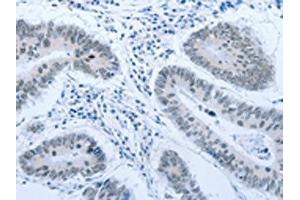 The image on the left is immunohistochemistry of paraffin-embedded Human colon cancer tissue using ABIN7189621(ACIN1 Antibody) at dilution 1/30, on the right is treated with synthetic peptide.