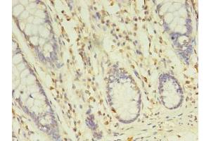 Immunohistochemistry of paraffin-embedded human colon cancer using ABIN7173349 at dilution of 1:100 (TREML2 抗体  (AA 19-268))