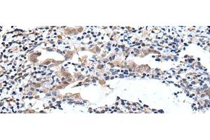 Immunohistochemistry of paraffin-embedded Human cervical cancer tissue using ELMO1 Polyclonal Antibody at dilution of 1:40(x200) (ELMO1 抗体)