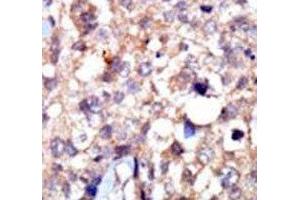IHC analysis of FFPE human breast carcinoma tissue stained with the ABL1 antibody