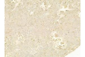 ABIN6263603 and ABIN6278495 at 1/100 staining human melanoma by IHC-P. (Netrin 1 抗体  (C-Term))