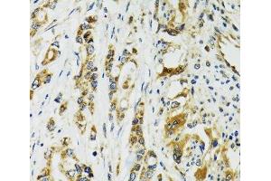 Immunohistochemistry of paraffin-embedded Human colon carcinoma using TNNC1 Polyclonal Antibody at dilution of 1:100 (40x lens). (TNNC1 抗体)