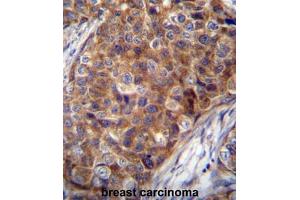 COX7A2L Antibody (Center) immunohistochemistry analysis in formalin fixed and paraffin embedded human breast carcinoma followed by peroxidase conjugation of the secondary antibody and DAB staining. (COX7A2L 抗体  (Middle Region))