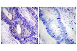 Immunohistochemical analysis of paraffin-embedded human colon carcinoma tissue using PKA α/β CAT (Phospho-Thr197) antibody (left)or the same antibody preincubated with blocking peptide (right). (PRKACA 抗体  (pThr197))