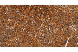 Immunohistochemistry of paraffin-embedded Human liver cancer using CDK19 Polyclonal Antibody at dilution of 1:70 (CDK19 抗体)
