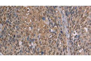 Immunohistochemistry of paraffin-embedded Human cervical cancer using CAB39 Polyclonal Antibody at dilution of 1:50 (CAB39 抗体)