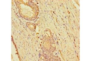 Immunohistochemistry of paraffin-embedded human prostate cancer using ABIN7157298 at dilution of 1:100 (KLHL38 抗体  (AA 1-200))