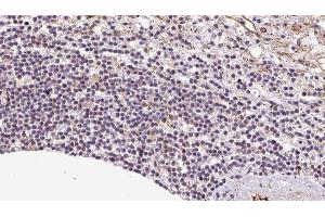 ABIN6273085 at 1/100 staining Human lymph cancer tissue by IHC-P. (VNN1 抗体)