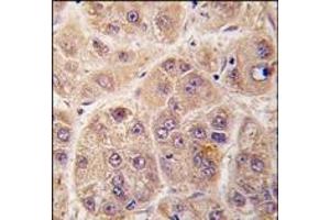Formalin-fixed and paraffin-embedded human hepatocarcinoma tissue reacted with PIM3 antibody (C-term), which was peroxidase-conjugated to the secondary antibody, followed by DAB staining. (PIM3 抗体  (C-Term))