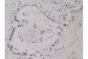 IHC-P analysis of Human Bile duct cancer Tissue, with DAB staining. (SHBG 抗体  (AA 51-218))