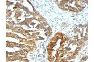 Formalin-fixed, paraffin-embedded human ovarian carcinoma stained with VEGF antibody (VEGF/1063). (VEGFA 抗体)