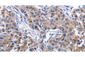 Immunohistochemistry of paraffin-embedded Human lung cancer tissue using MPO Polyclonal Antibody at dilution 1:50 (Myeloperoxidase 抗体)
