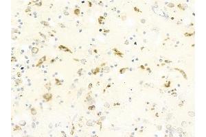 ABIN6264715 and ABIN6279710 at 1/100 staining human melanoma by IHC-P. (RFTN2 抗体  (C-Term))