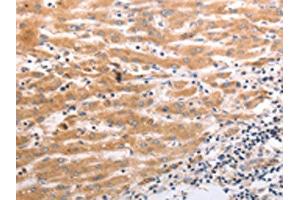 The image on the left is immunohistochemistry of paraffin-embedded Human liver cancer tissue using ABIN7190920(HCRTR1 Antibody) at dilution 1/70, on the right is treated with synthetic peptide.