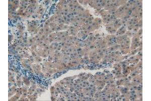 IHC-P analysis of Human Liver Cancer Tissue, with DAB staining. (APOC1 抗体  (AA 31-83))