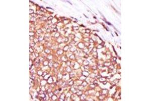 Formalin-fixed and paraffin-embedded human cancer tissue reacted with the primary antibody, which was peroxidase-conjugated to the secondary antibody, followed by DAB staining. (PKC theta 抗体  (C-Term))