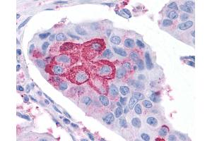 Anti-RORC / ROR Gamma antibody IHC of human Breast, Carcinoma. (RORC 抗体  (Ligand Binding Domain))
