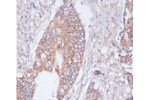 Immunohistochemistry of paraffin-embedded Human colon cancer using MBTPS1 Polyclonal Antibody at dilution of 1:100 (40x lens). (MBTPS1 抗体)