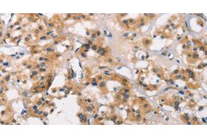 Immunohistochemistry of paraffin-embedded Human thyroid cancer using MARC1 Polyclonal Antibody at dilution of 1:40 (MOSC1 抗体)