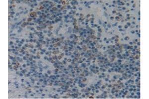 IHC-P analysis of Human Skin Cancer Tissue, with DAB staining. (Fibrillin 1 抗体  (AA 723-902))
