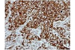 Immunohistochemistry: PPP3CB antibody staining of Paraffin-Embedded H661 Xenograft at 1/500 dilution. (PPP3CB 抗体)