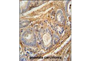 PCOTH antibody immunohistochemistry analysis in formalin fixed and paraffin embedded human prostate carcinoma followed by peroxidase conjugation of the secondary antibody and DAB staining. (PCOTH 抗体  (AA 14-42))