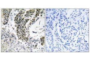 Immunohistochemistry analysis of paraffin-embedded human lung carcinoma tissue using RREB1 antibody. (RREB1 抗体  (Internal Region))