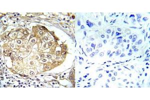 Immunohistochemical analysis of paraffin-embedded human breast carcinoma tissue using ERK1/2 (phospho- Thr202/Tyr204) (E012017). (ERK1/2 抗体  (pThr202, pTyr204))